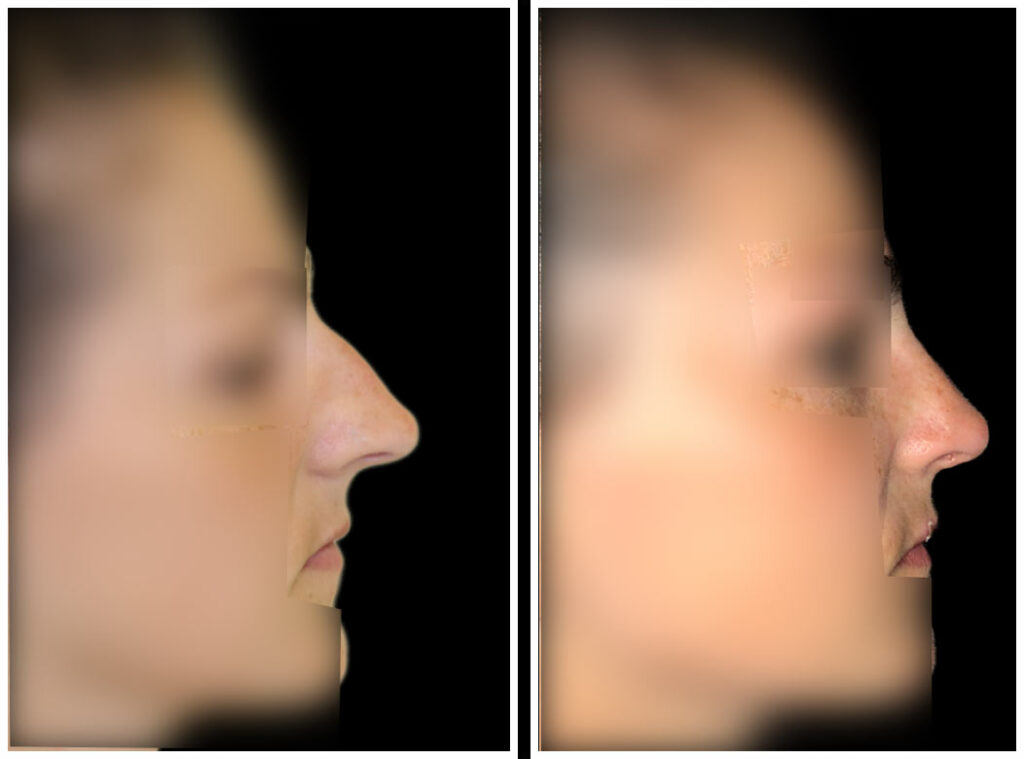 Female rhinoplasty before (left) and after (right), right lateral view