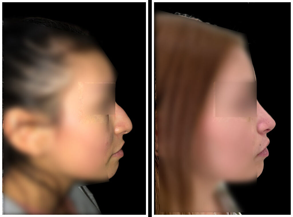 Female rhinoplasty before (left) and after (right), right lateral view