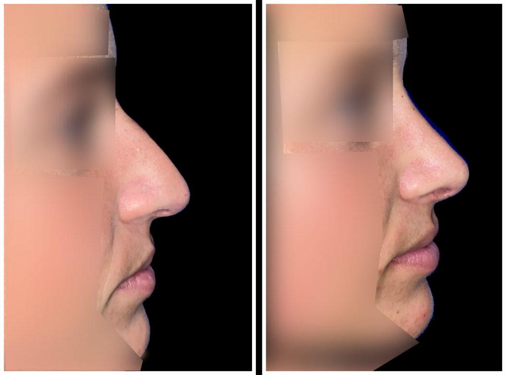 Female rhinoplasty before (left) and after (right), right lateral view