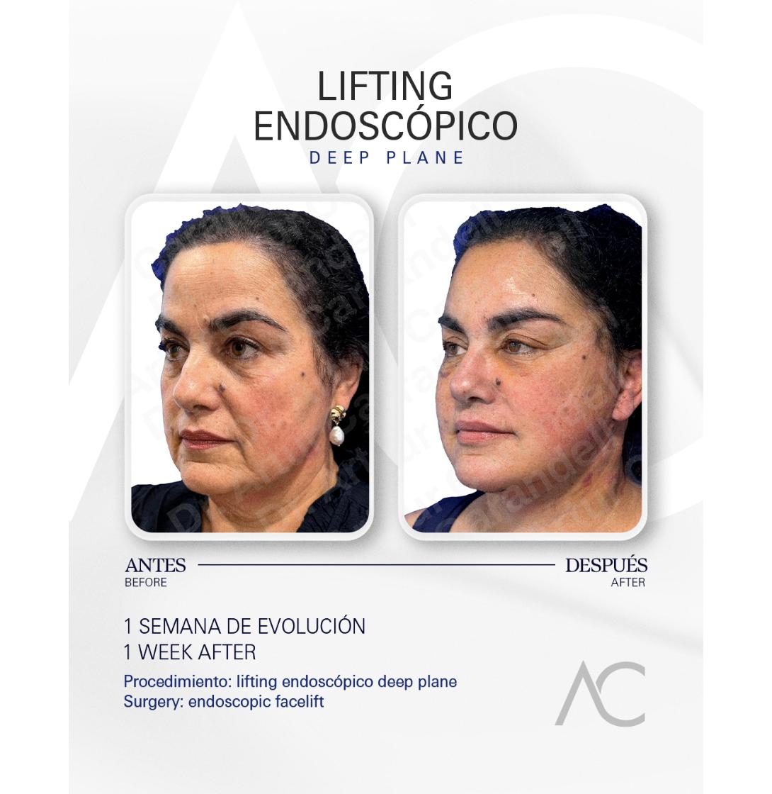Endoscopic Deep Plane Facelift: before and one week after surgery, three-quarter view