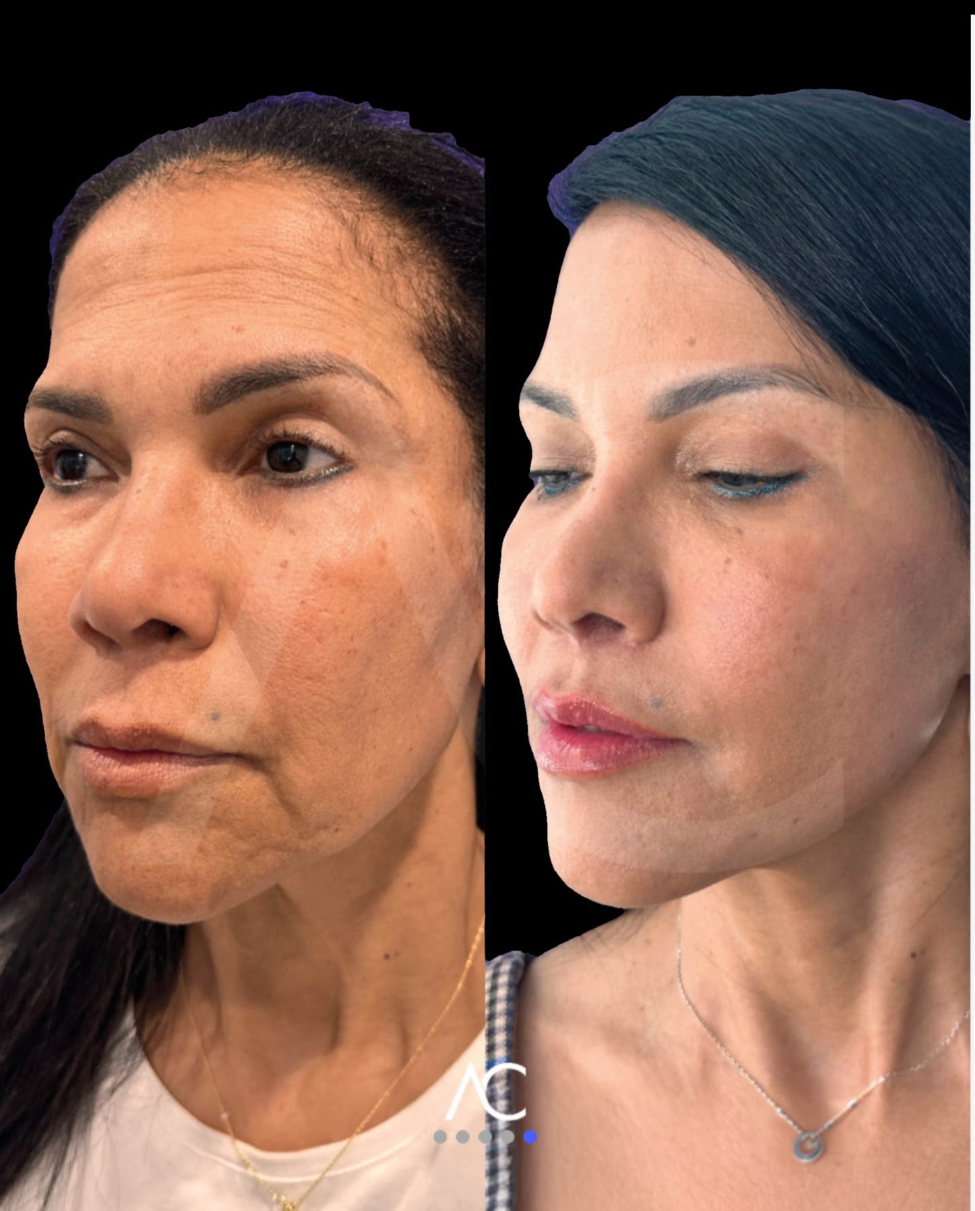 Endoscopic deep plane facelift before and after, Dr. Artur Díaz Carandell