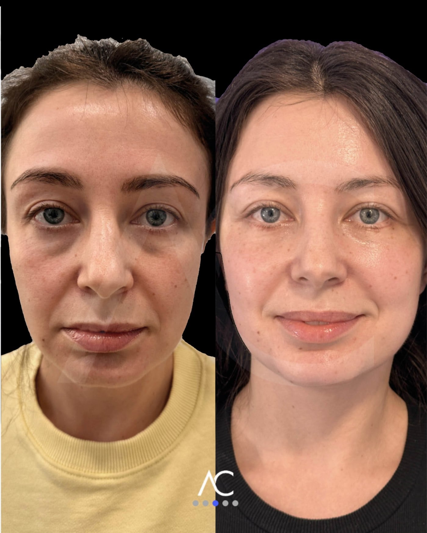 Endoscopic deep plane facelift before and after, Dr. Artur Díaz Carandell