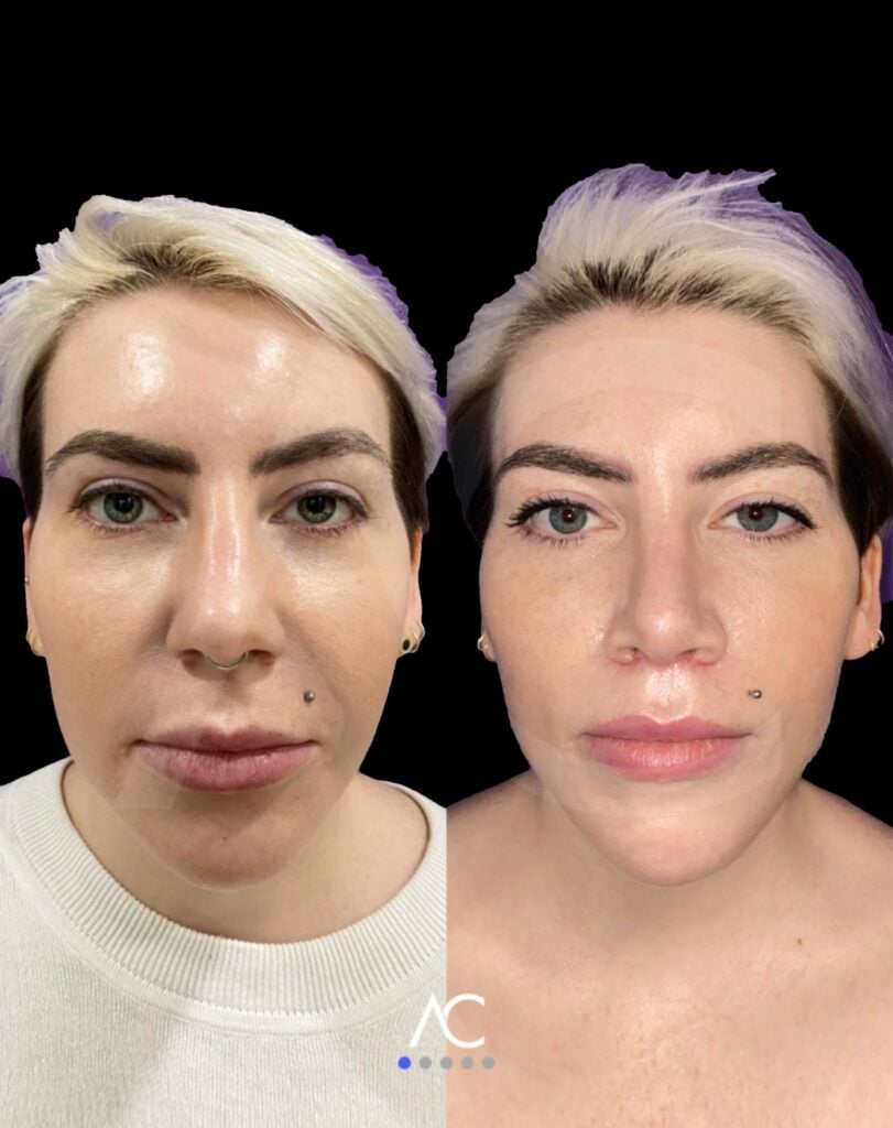 Endoscopic deep plane facelift — before and after, frontal view