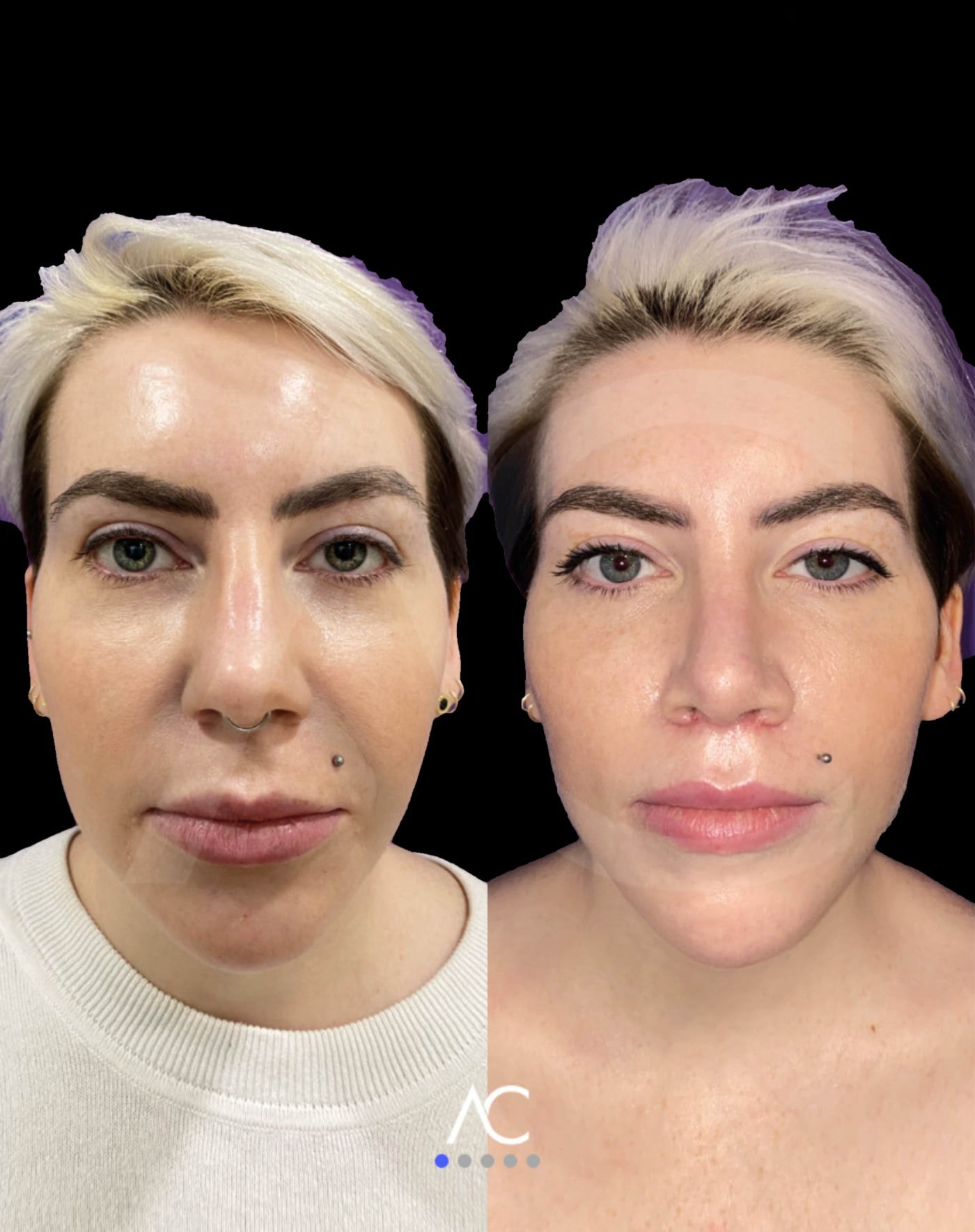 Endoscopic deep plane facelift before and after, Dr. Artur Díaz Carandell