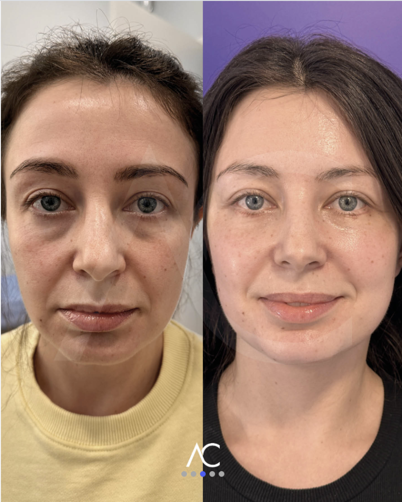 Endoscopic Deep Plane Facelift before and after, frontal view