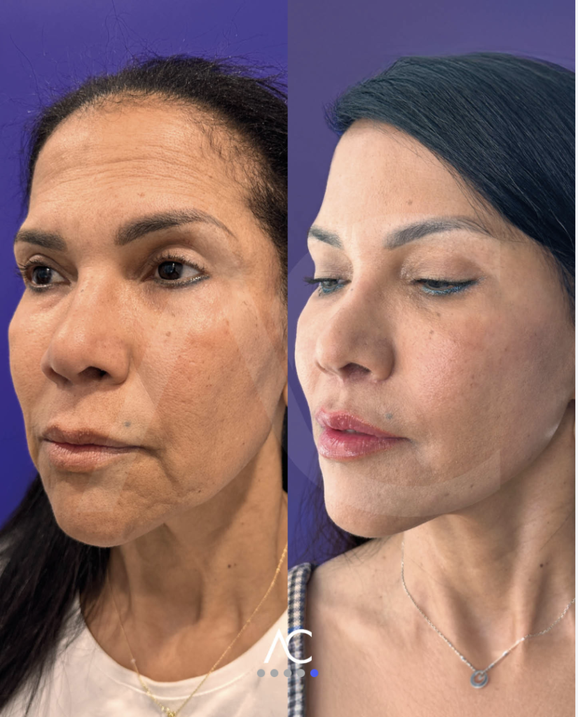 Endoscopic Deep Plane Facelift before and after, three-quarter view