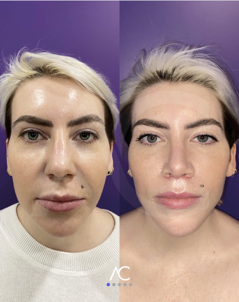 Endoscopic Deep Plane Facelift before and after, frontal view